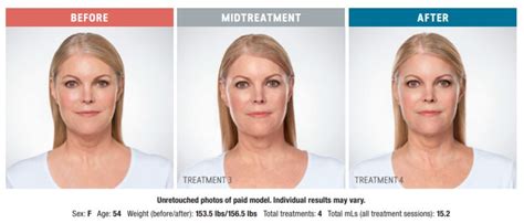 Kybella in Reno, Sparks & Hidden Valley, NV Reno NV